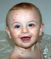 Double dose against chickenpox is better than one | Oye! Times